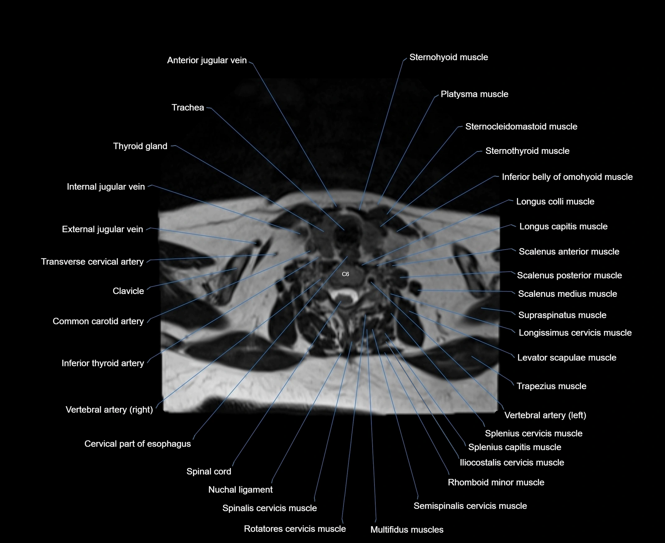 MRI Neck 3D labelled cross section anatomy axial 3t image-00001-00071.webp